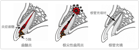 歯髄炎・根尖性歯周炎・根管充填